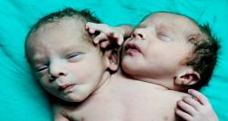 نوزاد با دو سر و ۳ دست در هند متولد شد