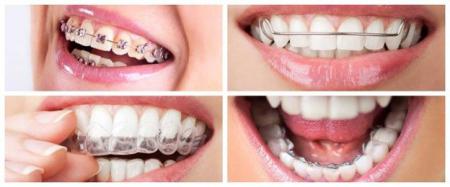 چه نوع ارتودنسی دندان برای شما مناسب است؟