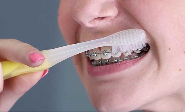 نحوه صحیح مسواک زدن دندان‌های ارتودنسی شده چگونه است؟