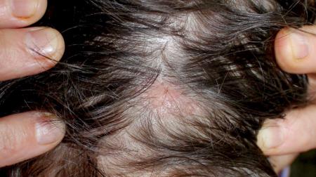 بهترین روش‌های کاشت مو و جلوگیری از ریزش مو کدامند؟