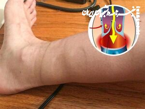 رد جوراب روی پا نشانه کدام بیماری است؟