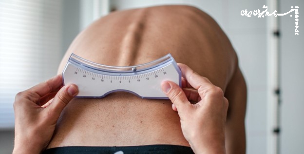 این نشانه‌های اسکولیوز را نادیده نگیرید و به پزشک مراجعه کنید