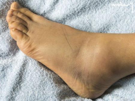 خطرات ناشی از تورم پاها در کلینیک دکتر ضربان