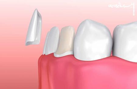 لمینت دندان: انواع، مزایا و عوارض آن