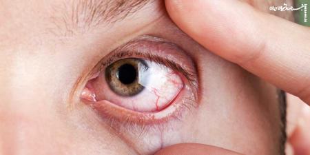 نحوه درمان خشکی چشم چگونه است؟ 