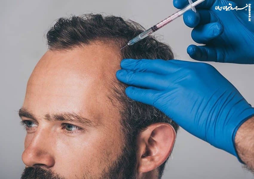 مزوتراپی چیست و چه تاثیری برای مو دارد؟