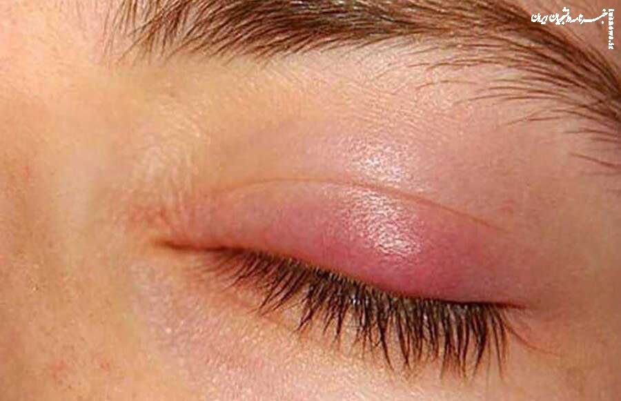 گل مژه چیست و چگونه درمان می‌شود؟