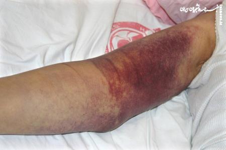 شناسایی ۱۸ بیمار مبتلا به تب کریمه کنگو در ایران