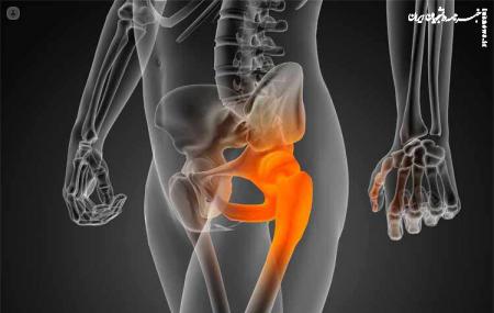 چه عواملی موجب شکستگی استخوان لگن می شود ؟