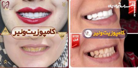  فرق کامپوزیت و لمینت دندان، کدام یک بهتر است؟ 