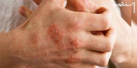 بیماری پوستی که پاییز و زمستان بیشتر است