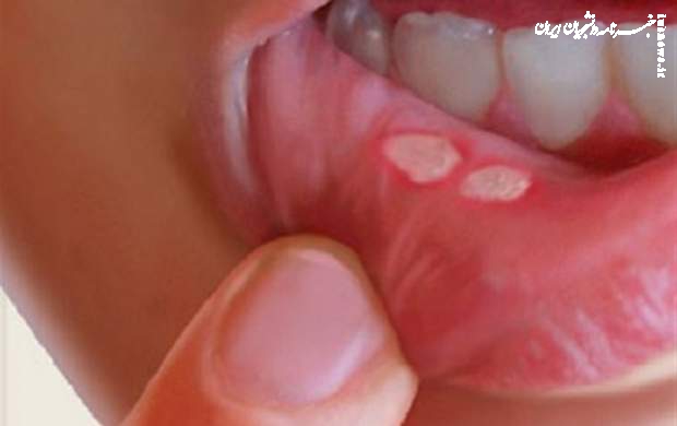 درمان آفت دهان با چند راهکار طب سنتی