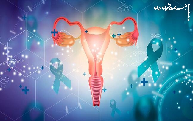 افزایش ۴ برابری احتمال سرطان تخمدان در زنان مبتلا به اندومتریوز