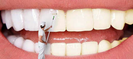 منظور از بلیچینگ دندان چیست؟