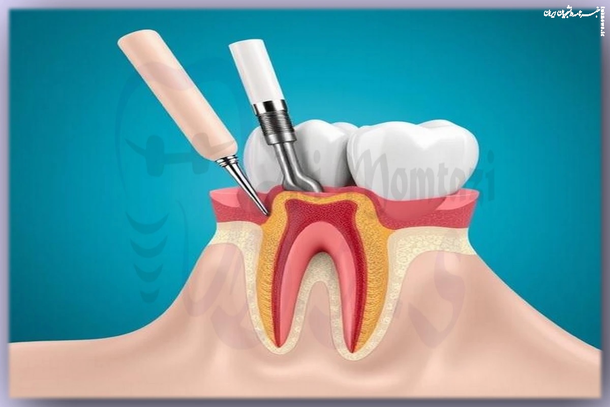 عصب کشی و ترمیم دندان زیبایی دکتر علی ممتازی