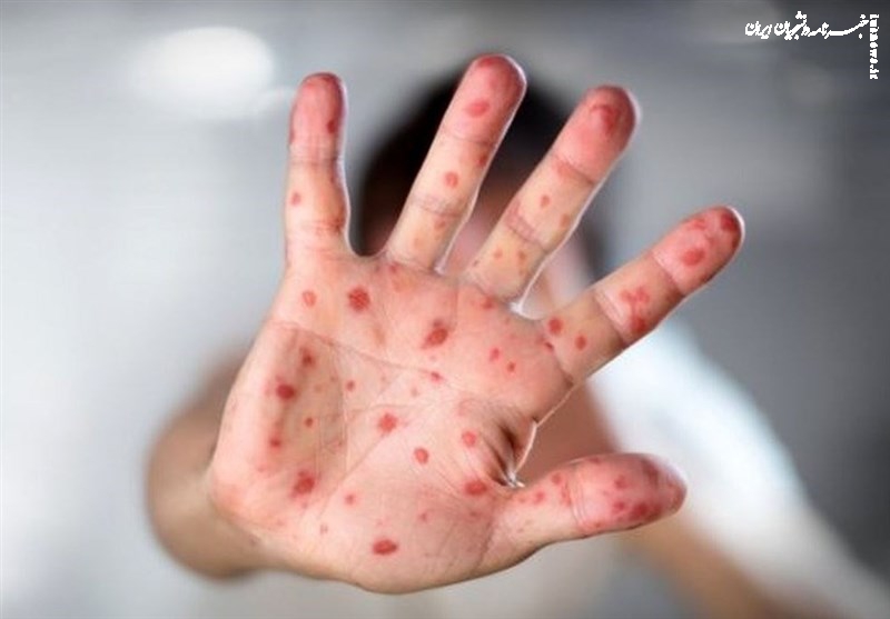 شناسایی ۶۷۴ مبتلا به «سرخک»؛ شیوع در ۳ کشور همسایه