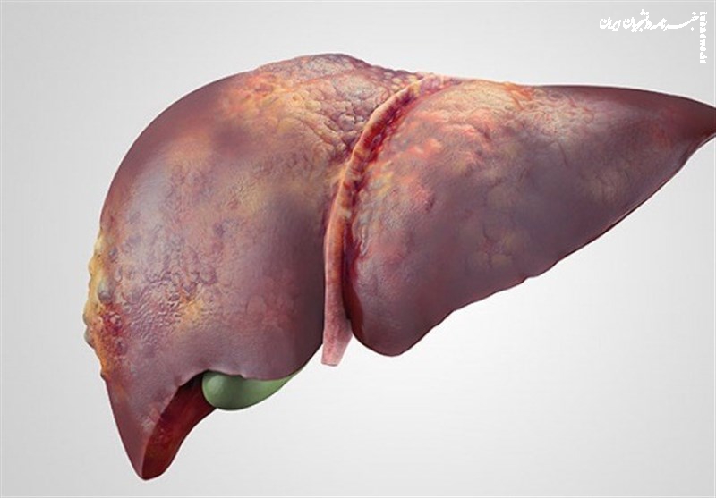 نیمی از ایرانی‌ها کبدچرب دارند