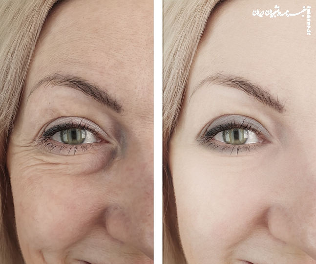 بلفاروپلاستی (جراحی زیبایی پلک): راهکار تخصصی برای رفع افتادگی و پف پلک