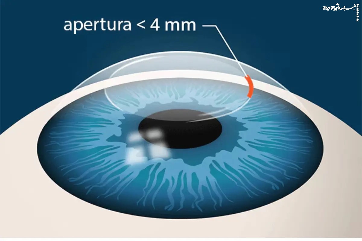 حداقل ضخامت قرنیه برای فمتولیزیک