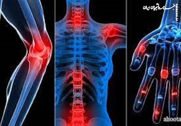سلول‌های بنیادی بندناف به کمک بیماران مبتلا به آرتروز آمد