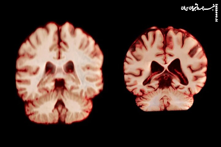 مغز مردان سریع‌تر از زنان کوچک می‌شود