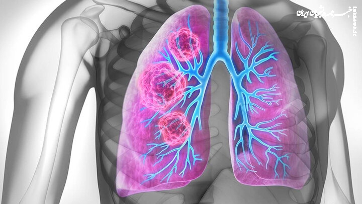 از هر ۵ بیمار مبتلا به سرطان ریه، یک نفر غیرسیگاری است