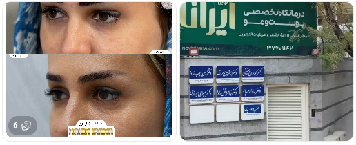  بهترین مراکز جراحی پلک در مشهد