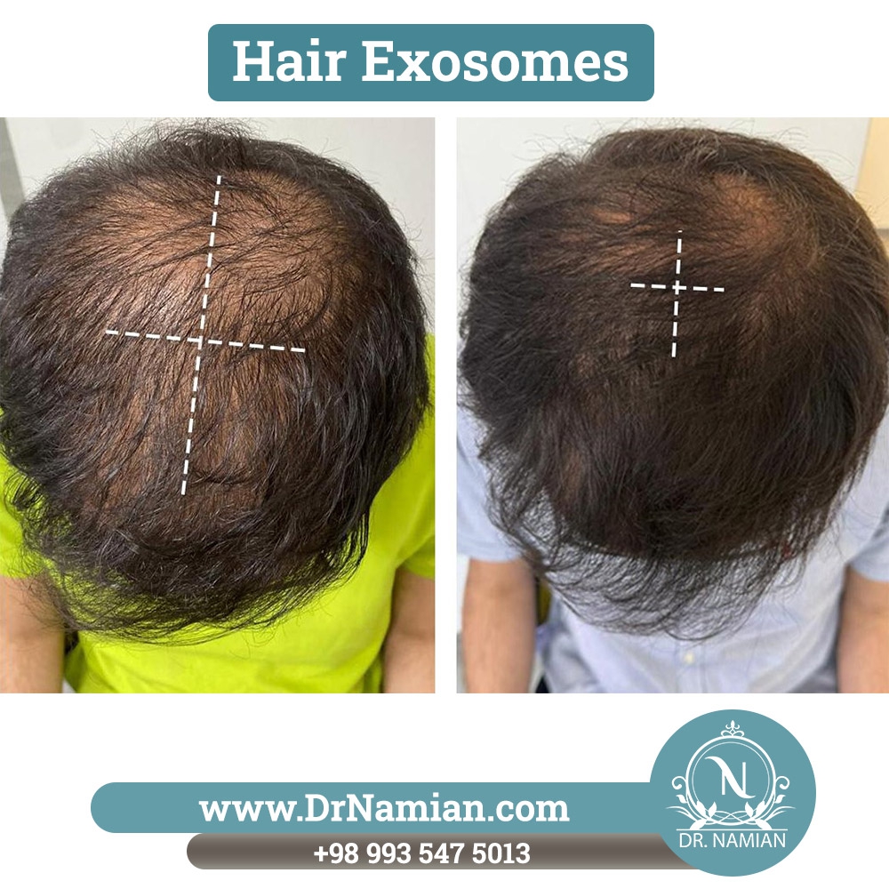 Treating hair loss with stem cell exosomes