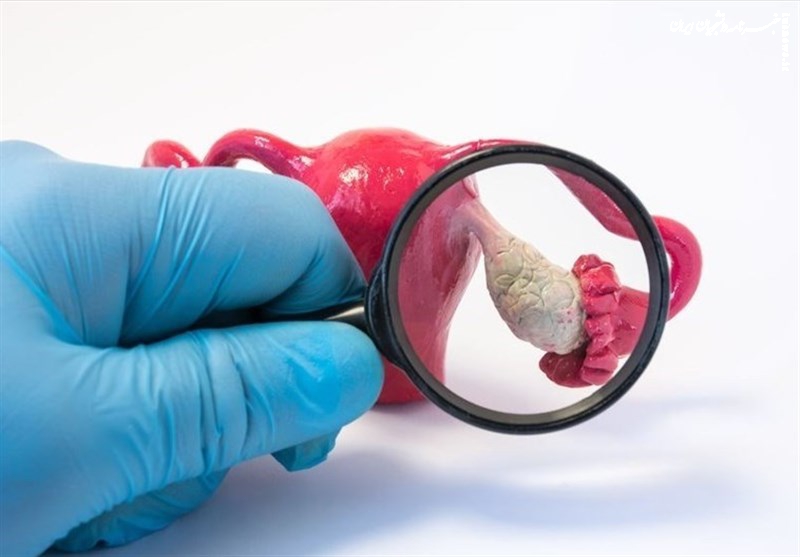 امید تازه برای زنان مبتلا به تخمدان پلی‌کیستیک