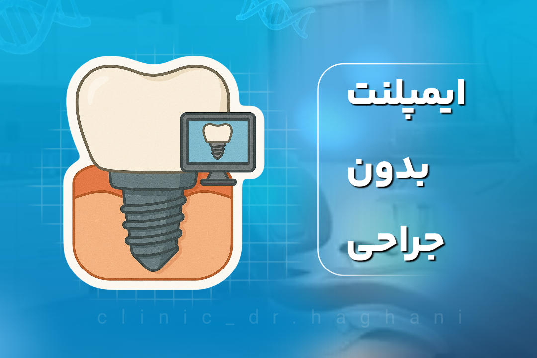 ایمپلنت بدون جراحی در تهران