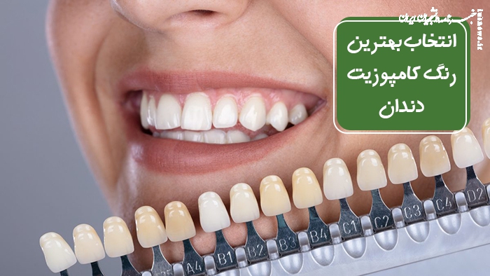 انتخاب بهترین رنگ کامپوزیت دندان