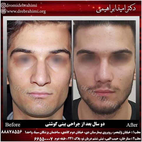 دوام نتیجه جراحی بینی چقدر است؟