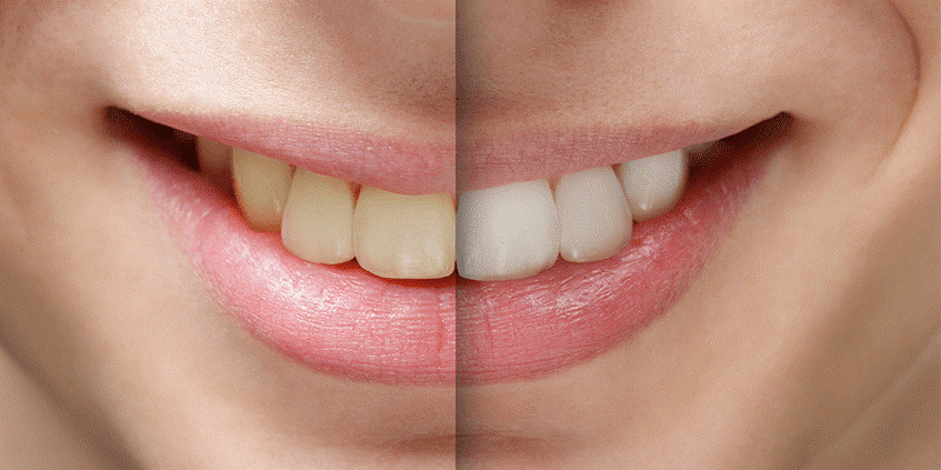 انواع روش‌های سفید کردن دندان(بلیچینگ) چیست؟