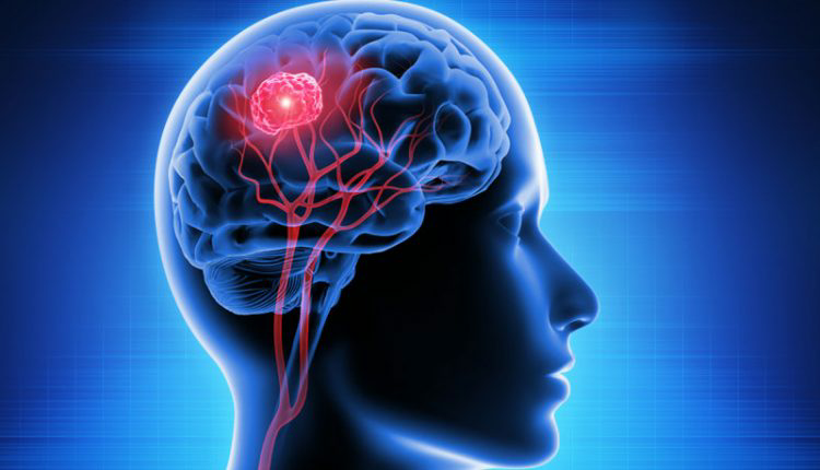 تومور مغز و هر آن چه از آن باید بدانیم 