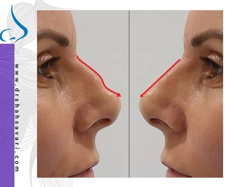 همه چیز درباره جراحی بینی