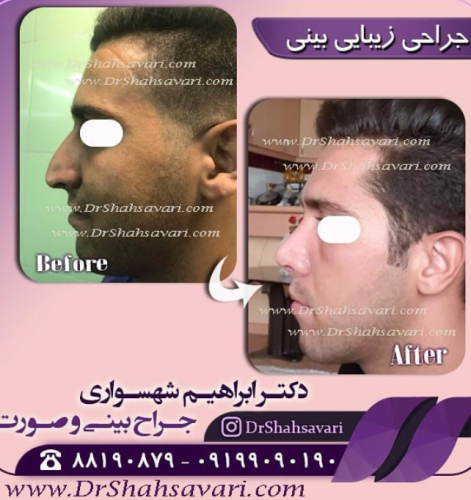 همه چیز درباره جراحی بینی