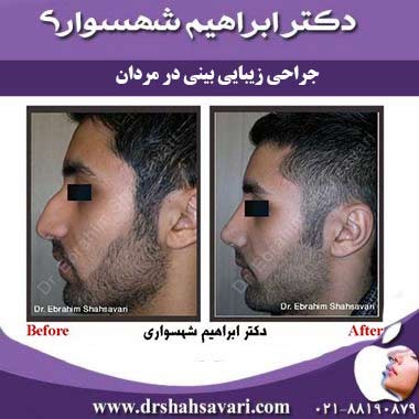 همه چیز درباره جراحی بینی