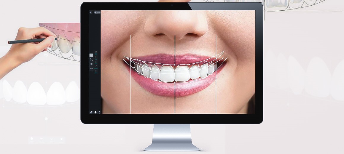 برای داشتن لبخندی زیبا کامپوزیت کنم یا لمینت؟