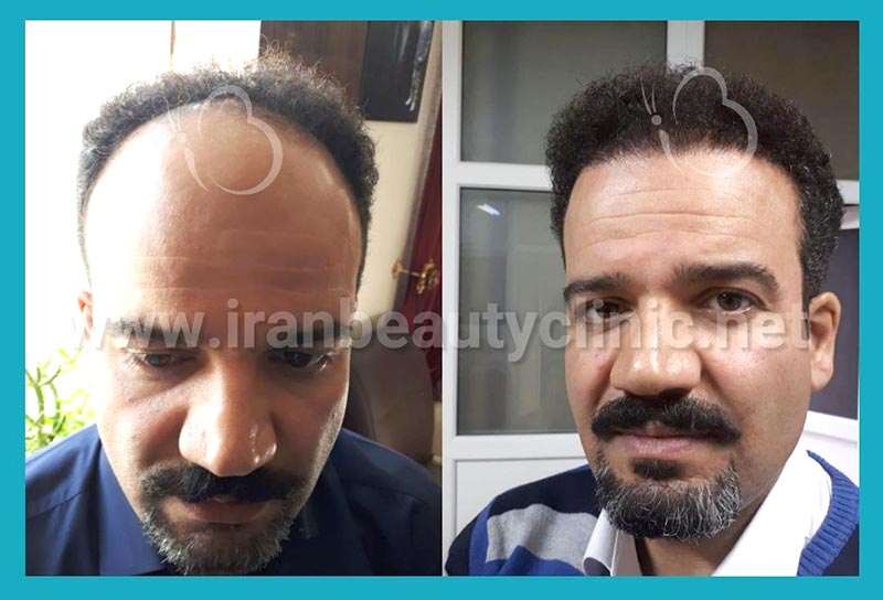 هزینه کاشت مو در سال ۱۴۰۰ چقدر است؟