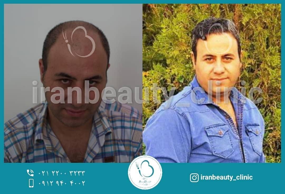 هزینه کاشت مو در سال ۱۴۰۰ چقدر است؟