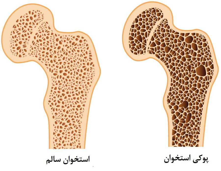 عوامل موثر بر پوکی استخوان