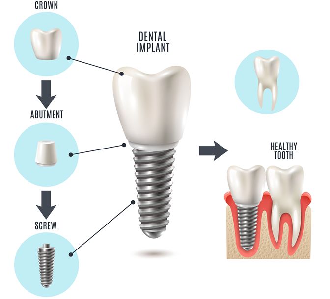 عوامل موثر بر قیمت کاشت دندان