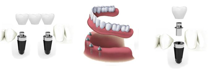 عوامل موثر بر قیمت کاشت دندان