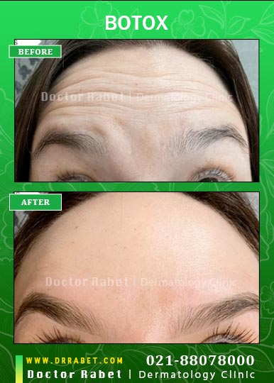 هزینه، میزان اثرگذاری و فواید بوتاکس پیشانی