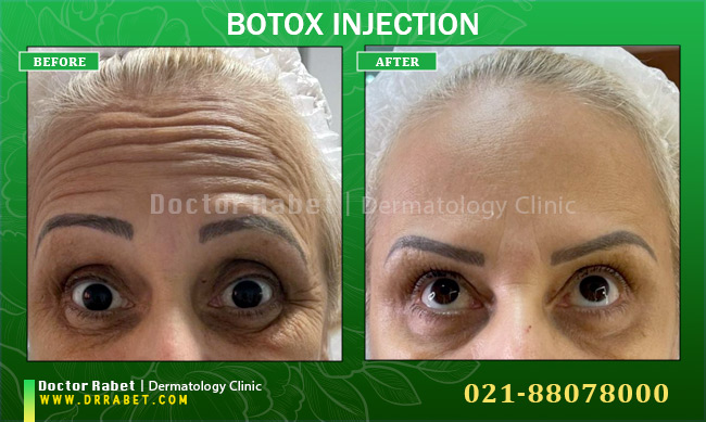 هزینه، میزان اثرگذاری و فواید بوتاکس پیشانی