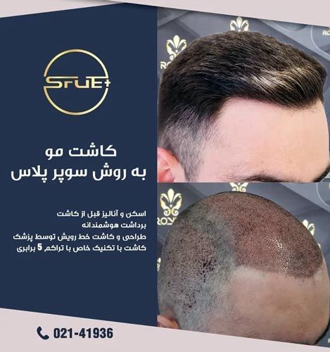 از کاشت مو و مراحل و روش‌های آن چه می‌دانید؟