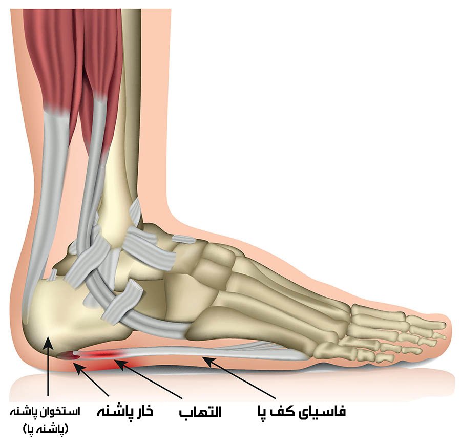 چگونه ورزشکاران میتوانند از خار پاشنه در کف پا جلوگیری کنند و یا درمانش کنند؟
